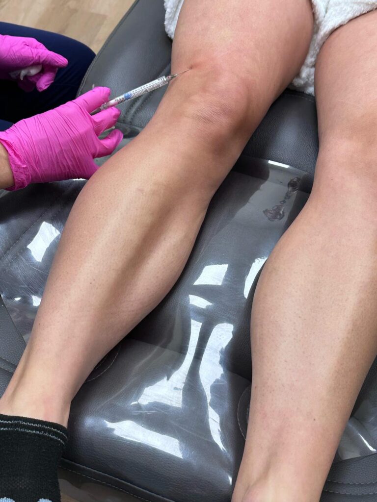 A biostimulator treatment being performed on a client's legs