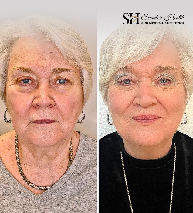 Before and after microneedling and wrinkle relaxer results on a mature woman