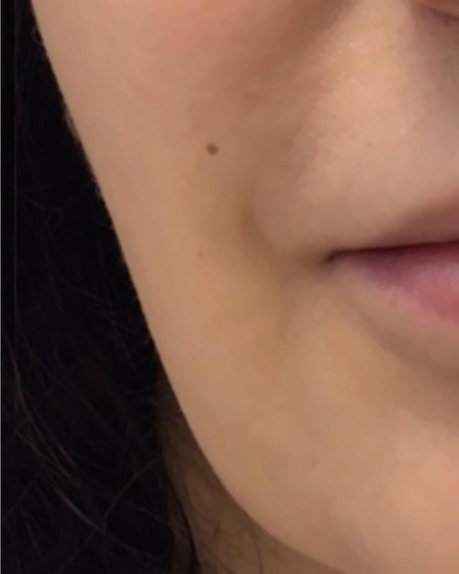 Seamless Health patient after fat dissolving treatment, showing a defined jawline and smoother chin