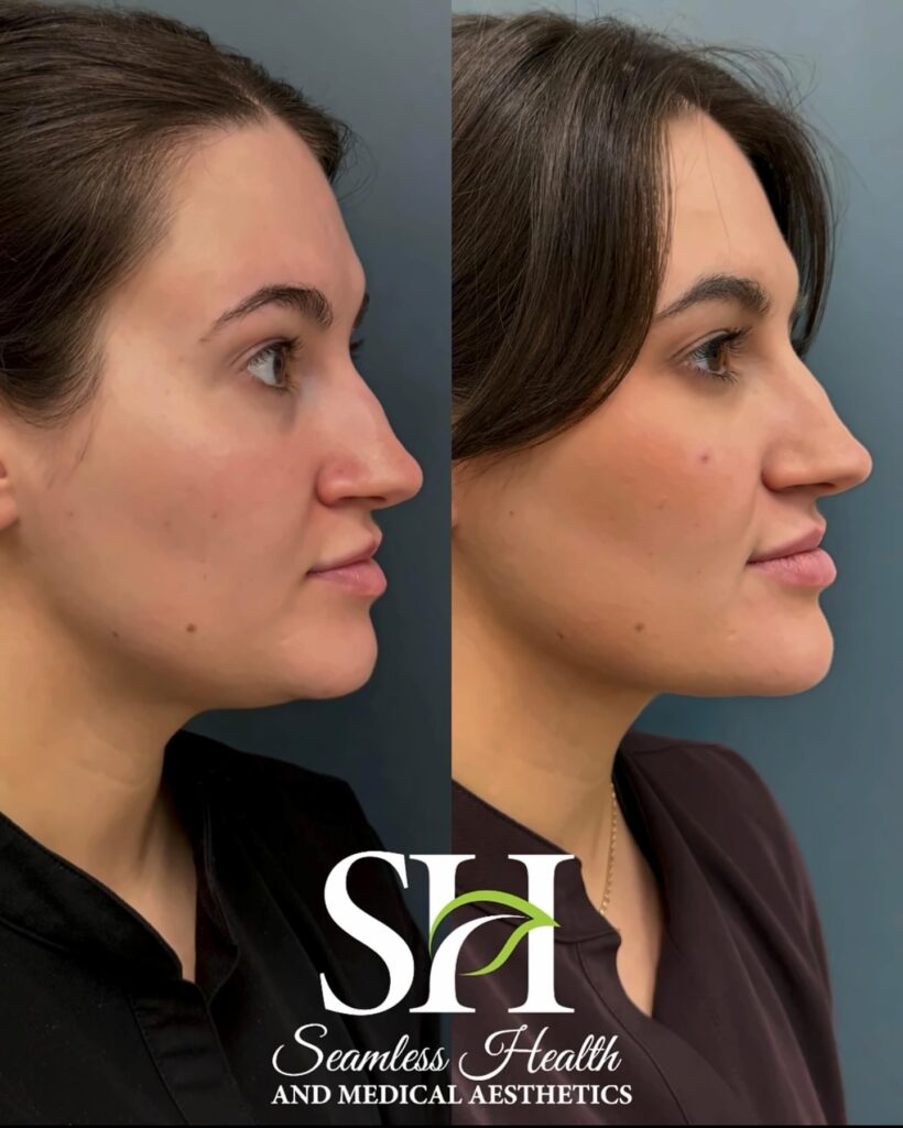 Seamless Health fat dissolving patient before and after showing a sharper jawline and reduced submental fullness