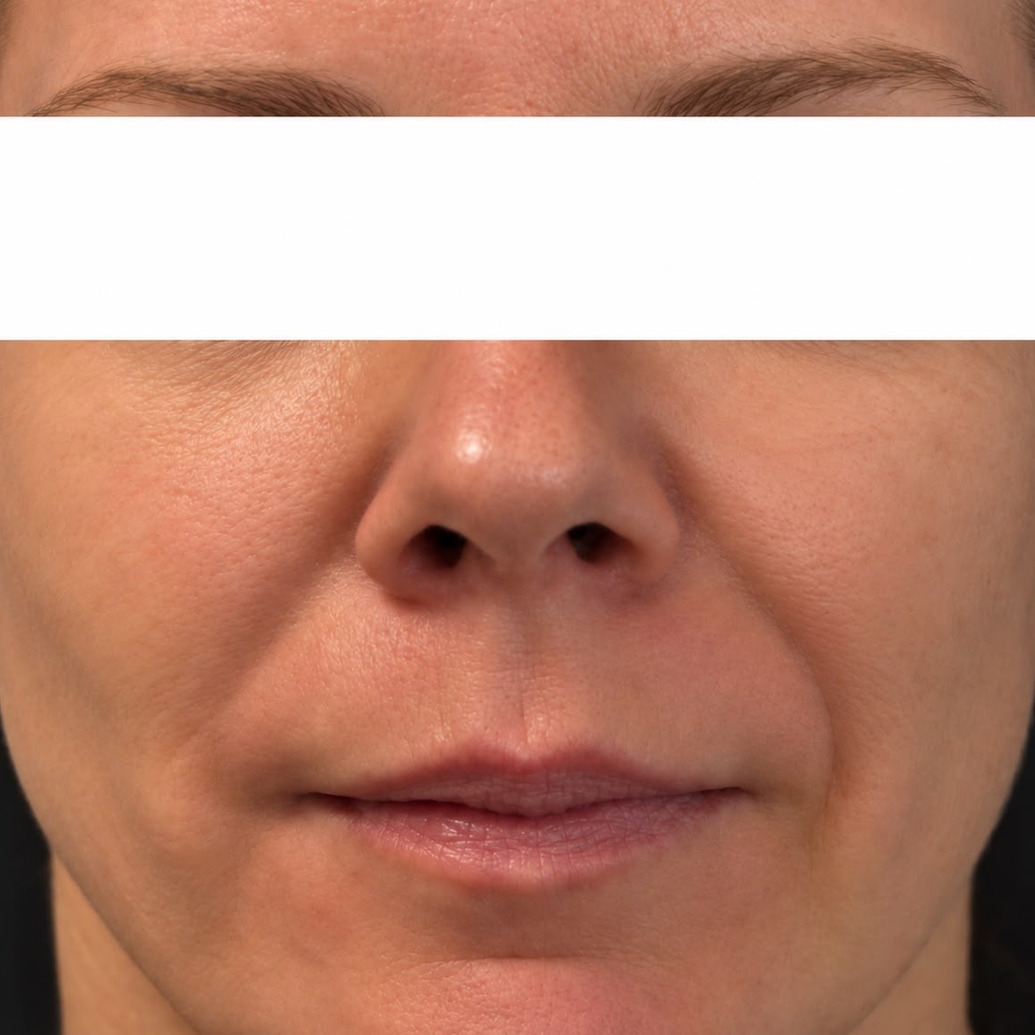 Seamless Health patient after IPL photofacial, showing calmer and more even skin tone