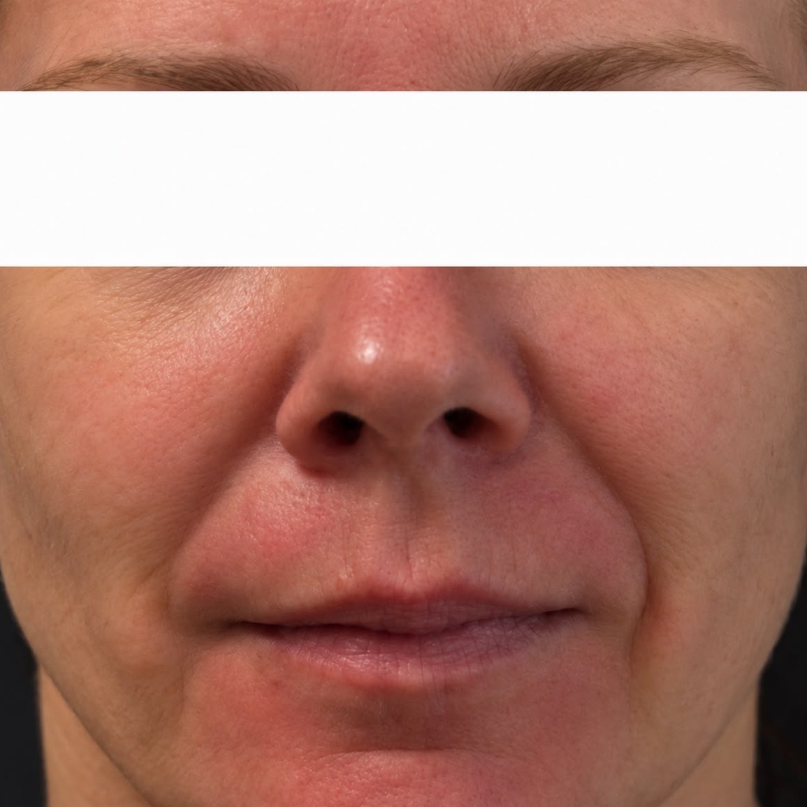 Seamless Health patient before IPL photofacial, showing facial redness and flushing