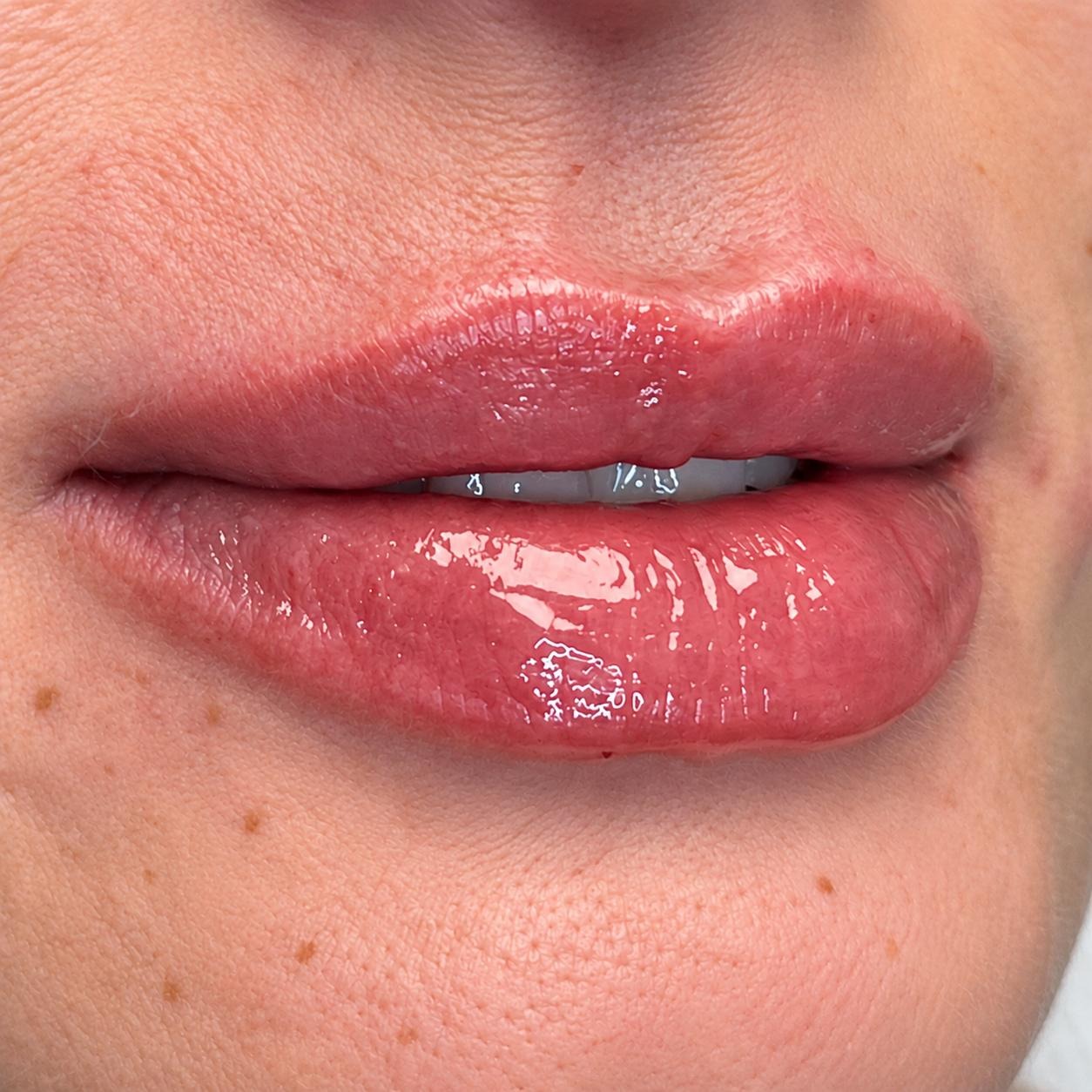 Seamless Health patient after lip filler treatment showing added volume and definition