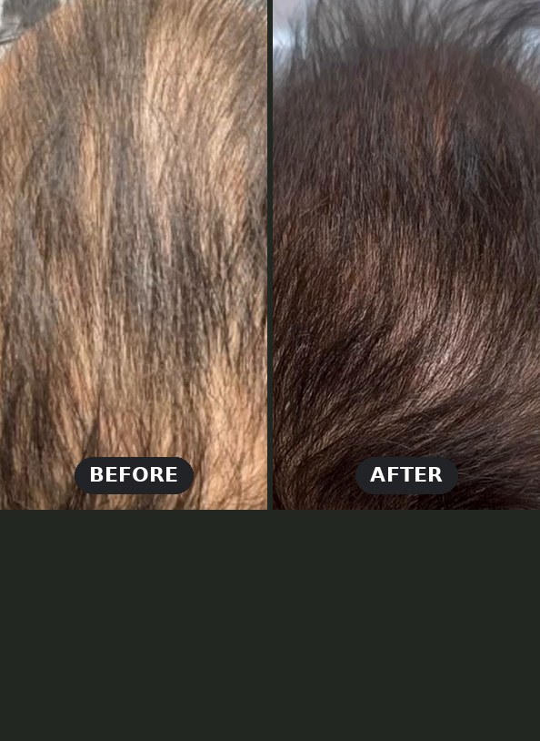 PRP for hair loss before and after at Seamless Health