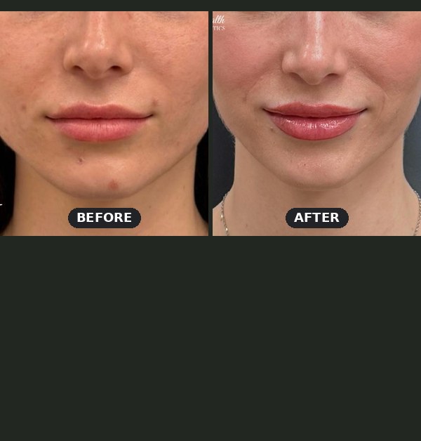 Masseter Botox for TMJ and jaw clenching, before and after at Seamless Health