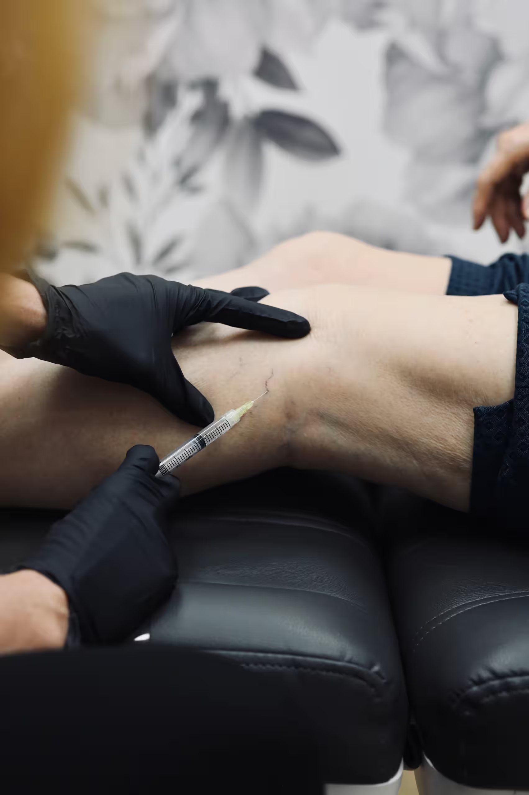 What to Do Before and After Sclerotherapy Treatment