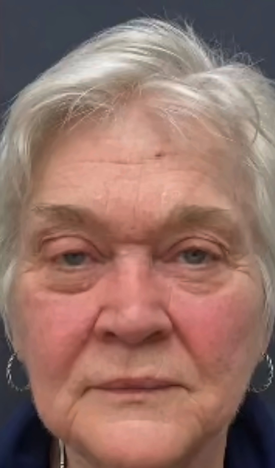 Seamless Health patient before CO2 skin resurfacing