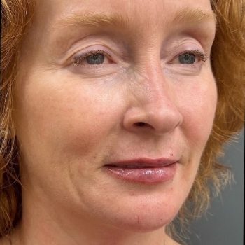 The same Seamless Health patient after dermal filler, with softer smile lines and fuller lips