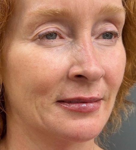 The same Seamless Health patient after dermal filler, with softer smile lines and fuller lips