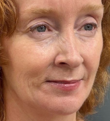 Seamless Health patient before dermal filler to the cheeks and lips