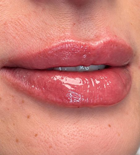 The same Seamless Health patient after lip filler, with fuller, more defined lips