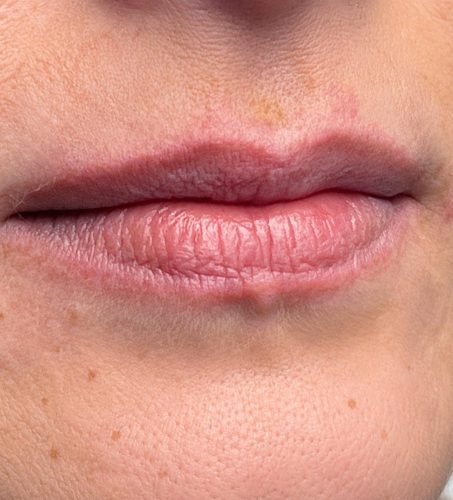 Seamless Health patient before lip filler