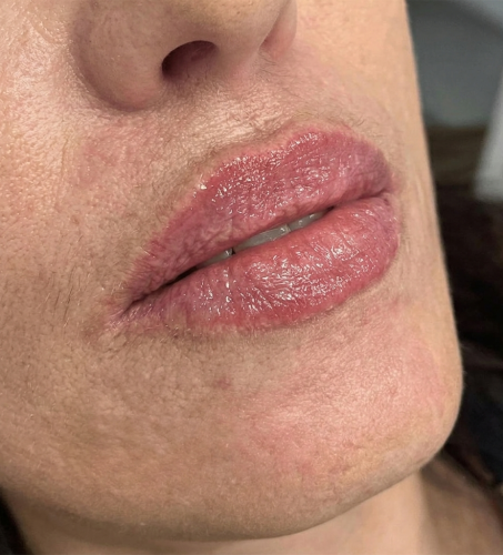 lips_after_2