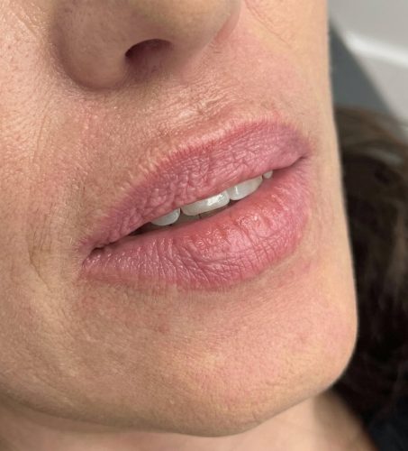 lips_before_2-web